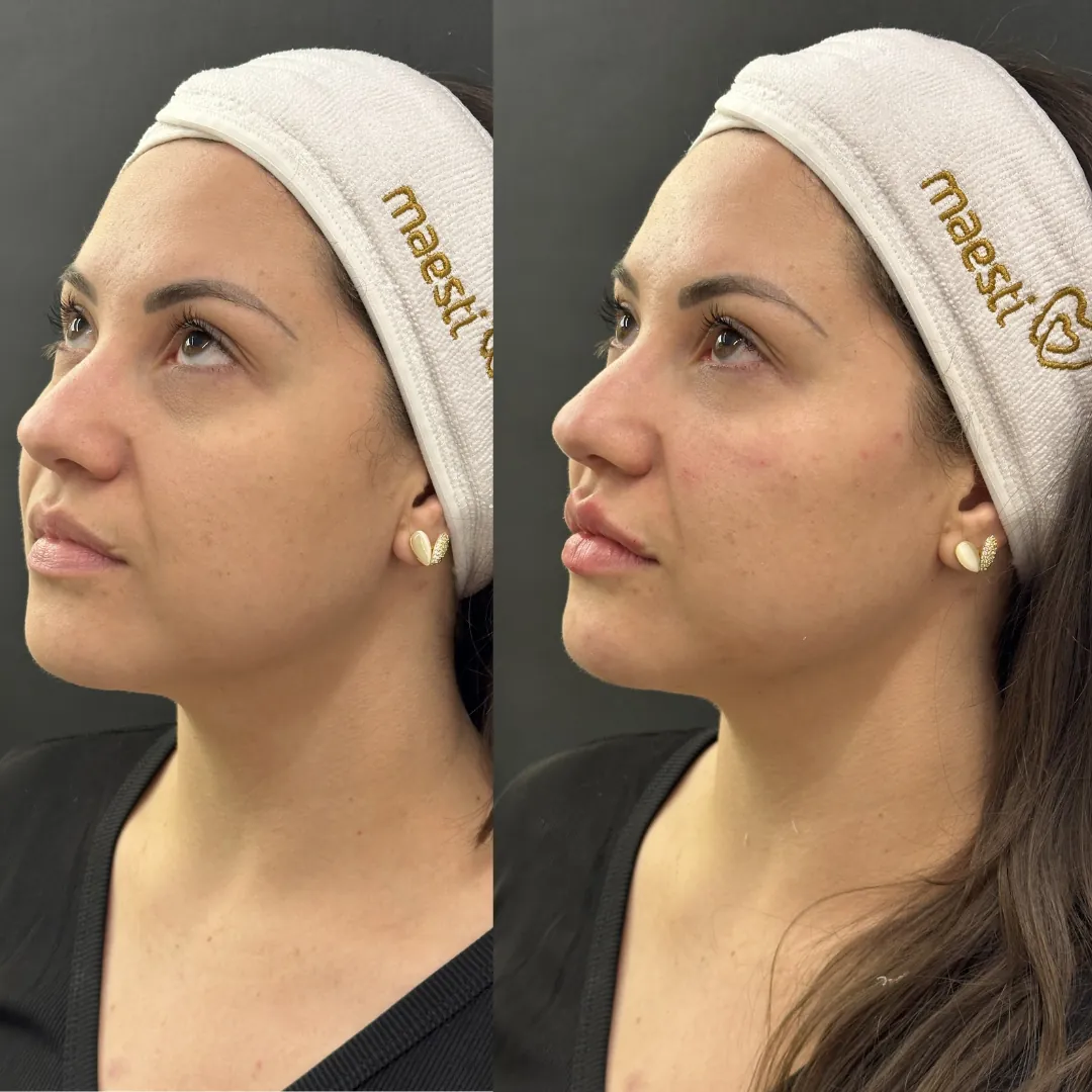 Antes e depois de harmonização facial — olhar descansado e contorno mais definido