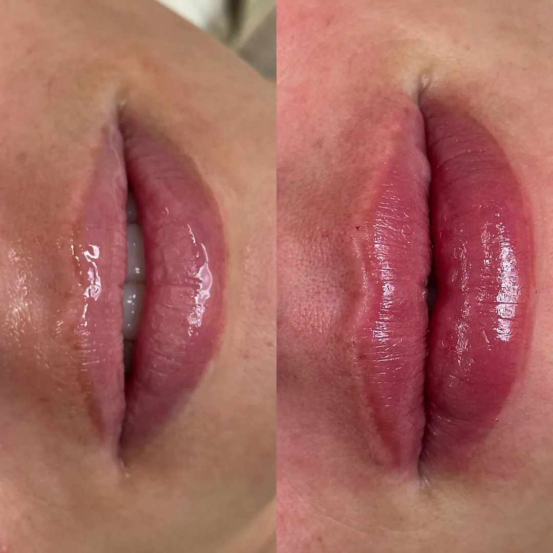 Antes e depois de preenchimento labial — lábios com mais volume e contorno definido