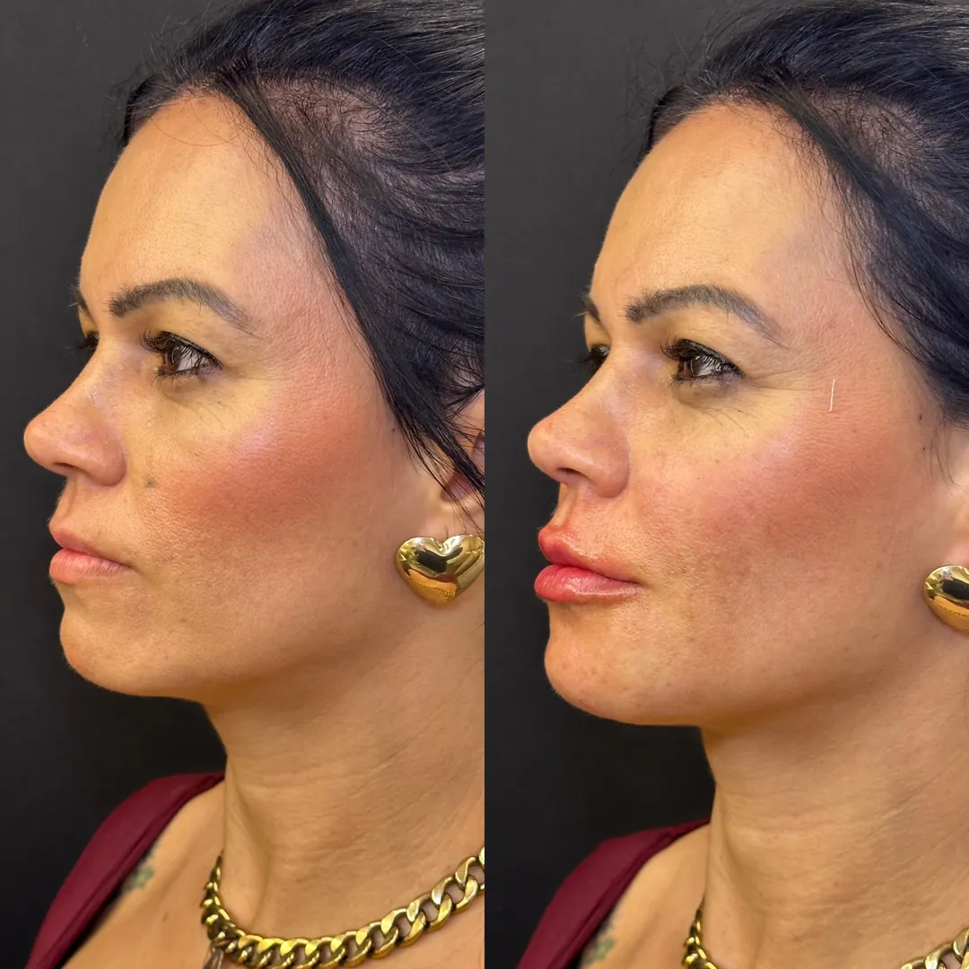Antes e depois de preenchimento labial visto de perfil — projeção e equilíbrio do sorriso