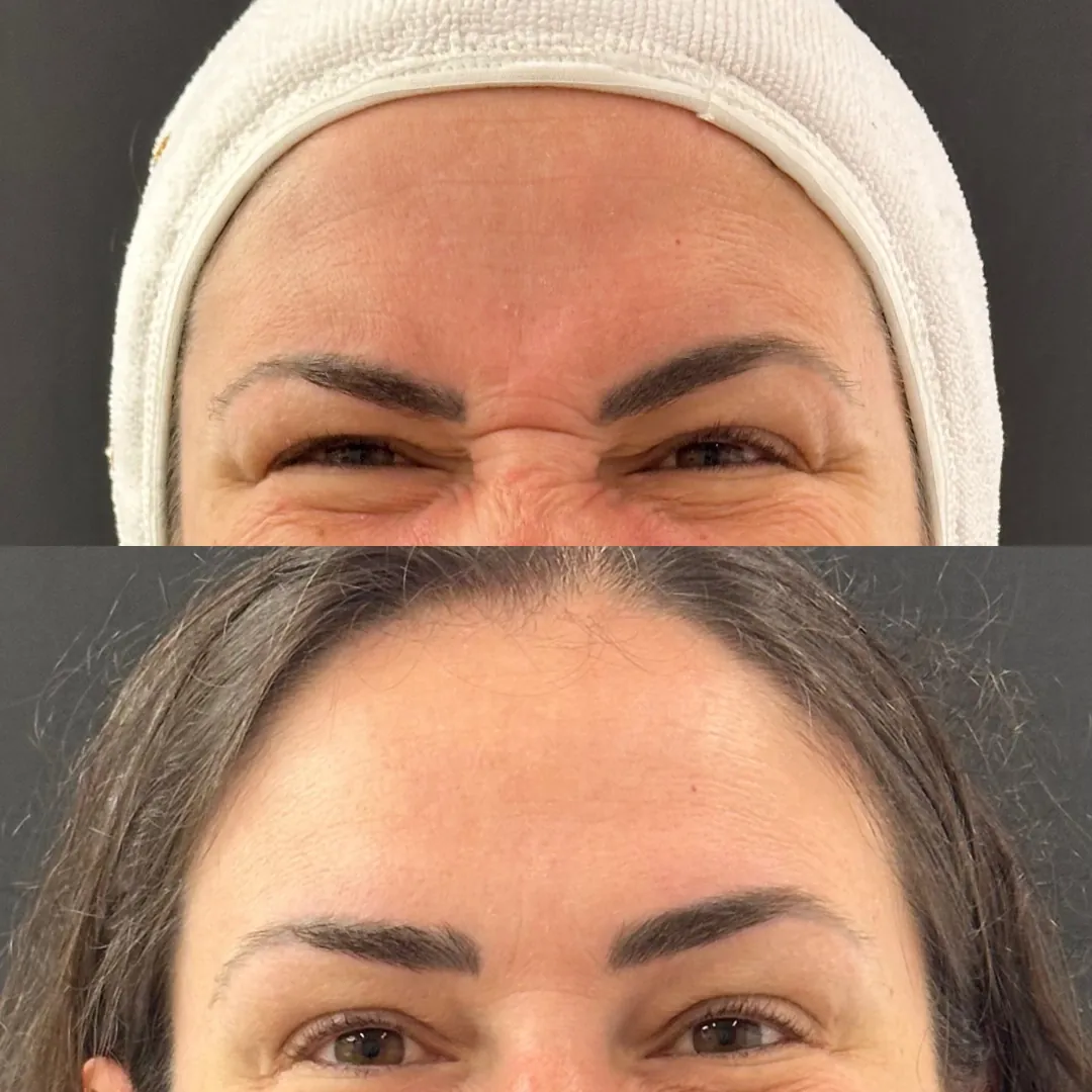 Antes e depois de toxina botulínica na glabela — expressão relaxada entre as sobrancelhas